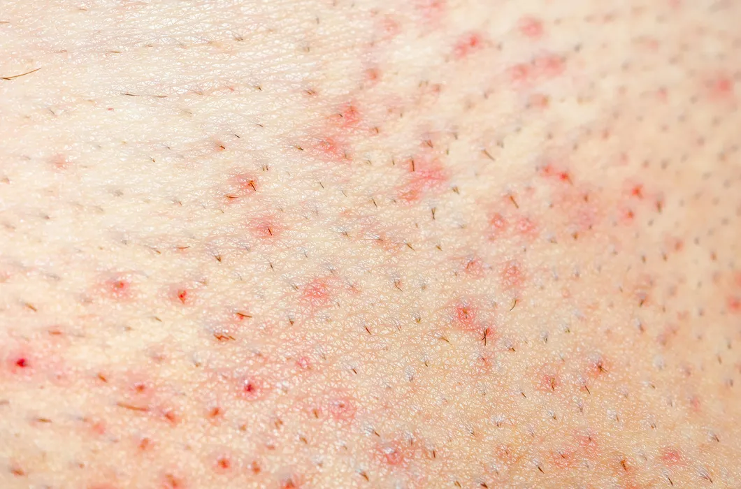Eingewachsene Haare: Warum entstehen sie und wie verhindern?